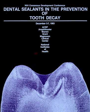 “国家卫生研究院预防蛀牙的牙科密封剂”